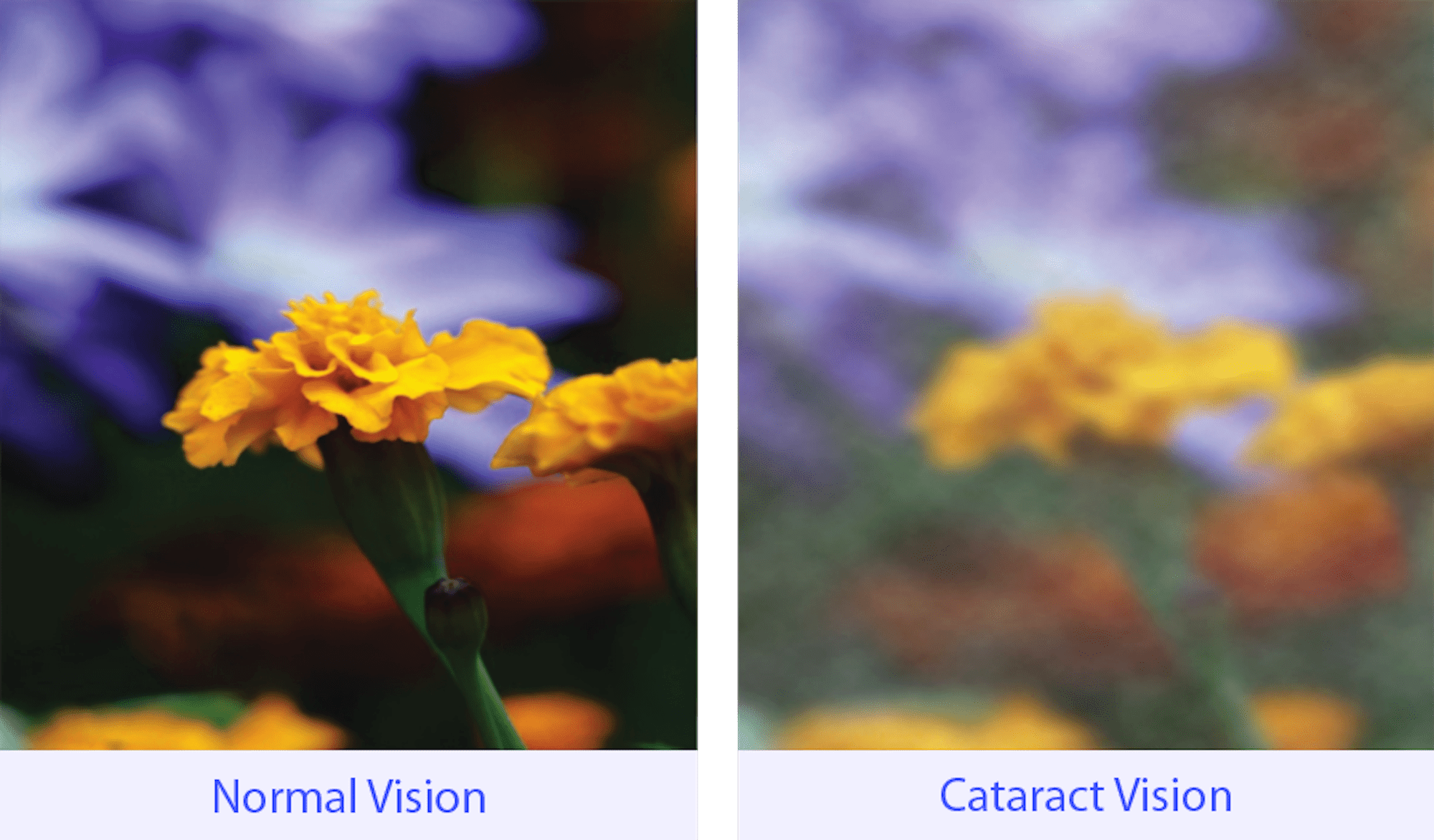 Cataract